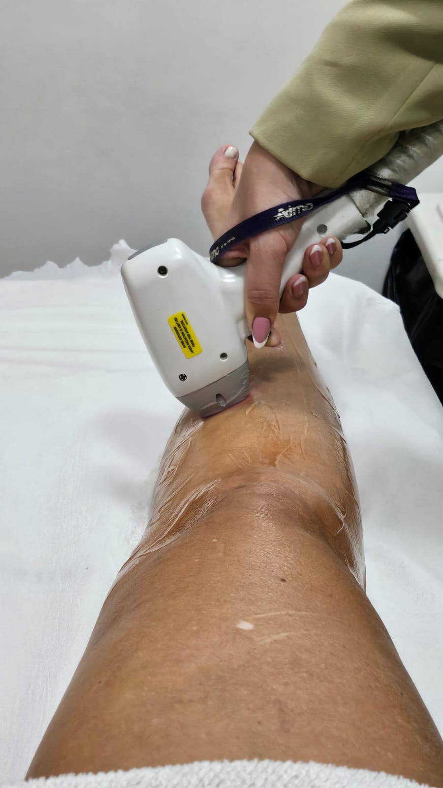 Depilação a Laser na Estética Crisalys: Suavidade Duradoura e Conforto Sem Igual