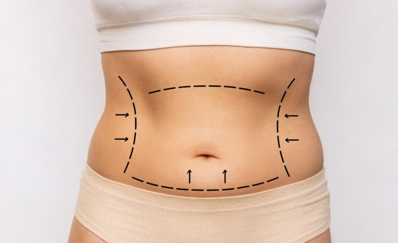 A Importância do Repouso e Tratamento Pós-Operatório Após a Abdominoplastia: Diretrizes da Estética Crisalys