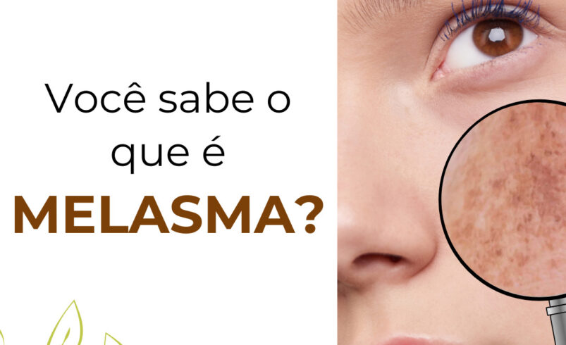 Melasma: Causas e Tratamentos na Estética Crisalys