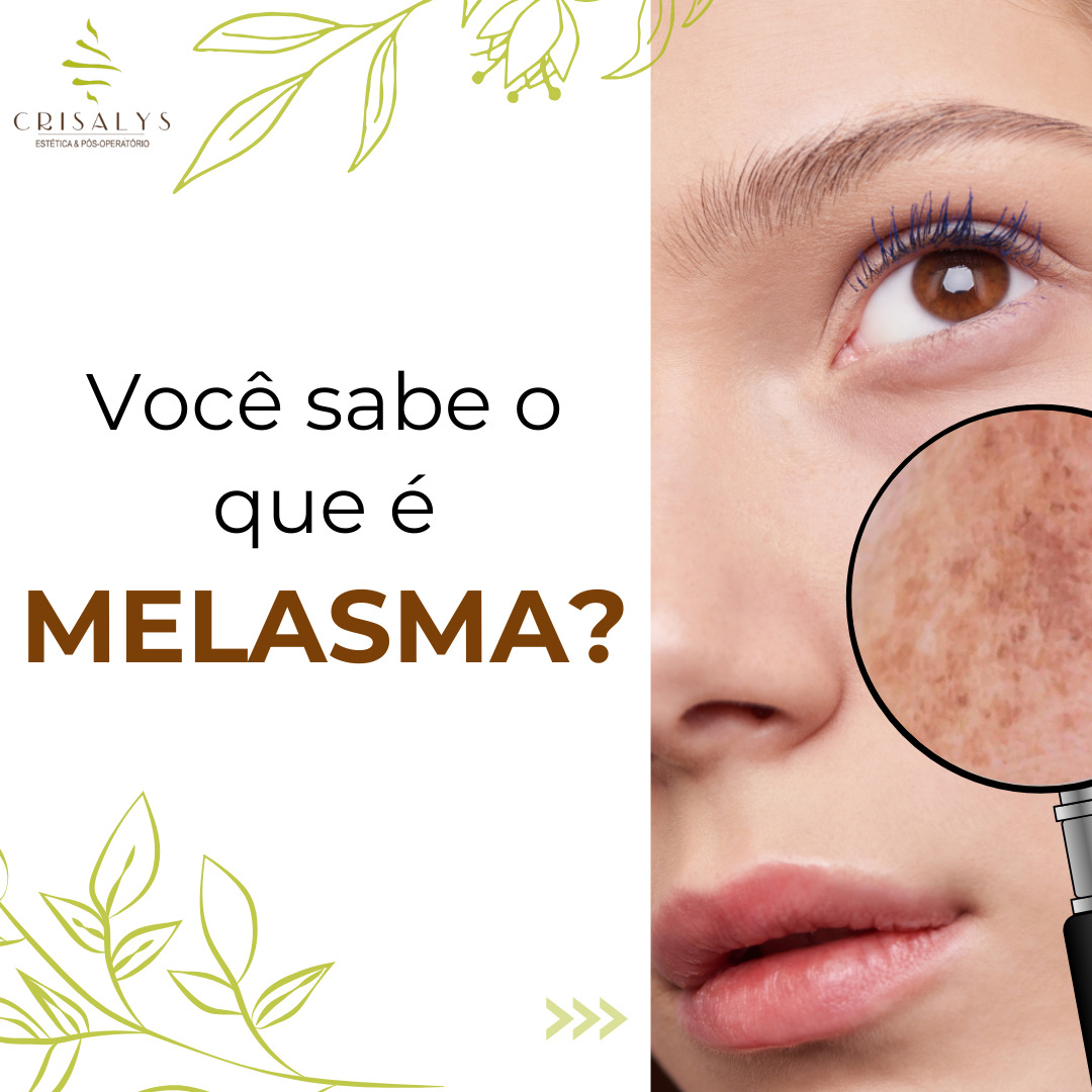 Melasma: Causas e Tratamentos na Estética Crisalys