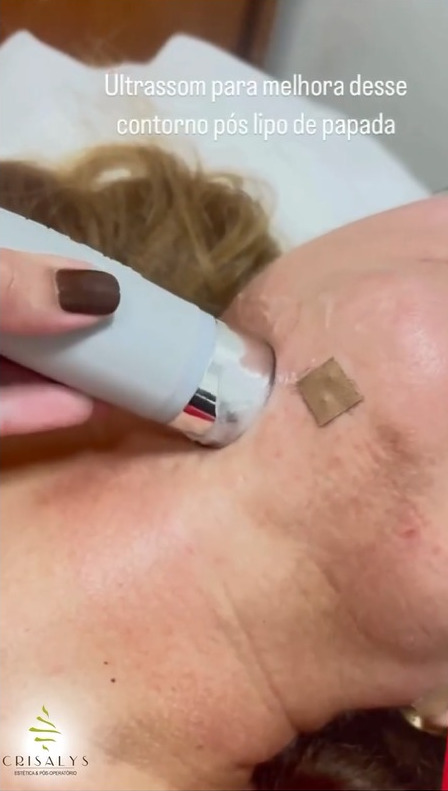 PÓS-OPERATÓRIO DA LIPO DE PAPADA: GUIA COMPLETO PARA UMA RECUPERAÇÃO RÁPIDA, SEM INCHAÇO E COM O CONTORNO DESEJADO