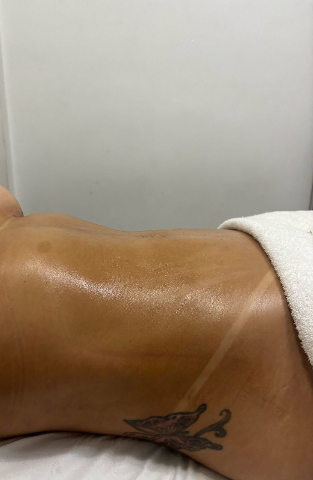 pos-operatorio-prevencao-de-fibrose-crisalys-estetica-pos-operatorio-santo-andre-abc-paulista