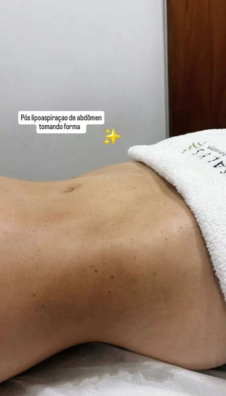 estetica-pos-operatorio-cirurgia-plastica-corporal-e-efacial-santo-andre-abc-paulista-crisalys-estetica