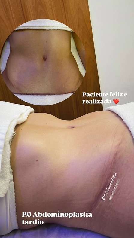 estetica-pos-operatorio-cirurgia-plastica-corporal-e-efacial-santo-andre-abc-paulista-crisalys-estetica